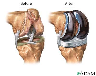 total-knee-replacement