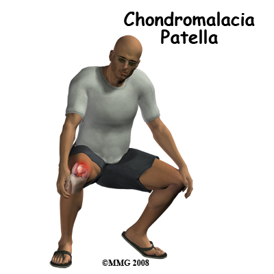 Chondromalacia_Patellae