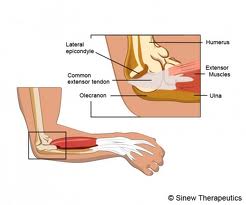 Elbow Hyperextension Injury