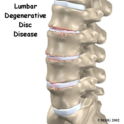 degenerative-disc-disease