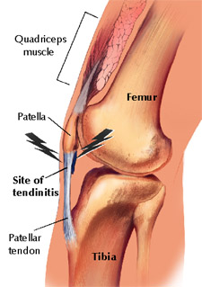 patellar-tendon-tear