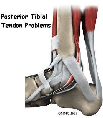 posterior-tibial-tendon