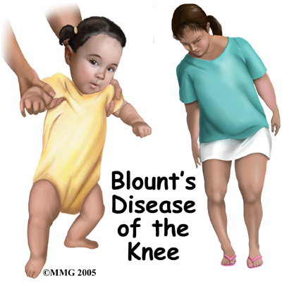 Blounts disease