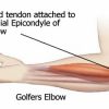 Golfers-Elbow-pain