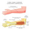 cubital-tunnel-syndrome-elbow-pain